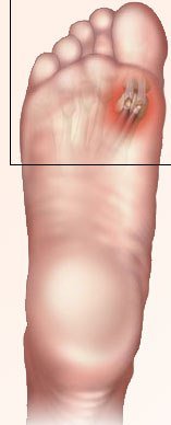 La Sesamoidite Sintomi Cause E Trattamento